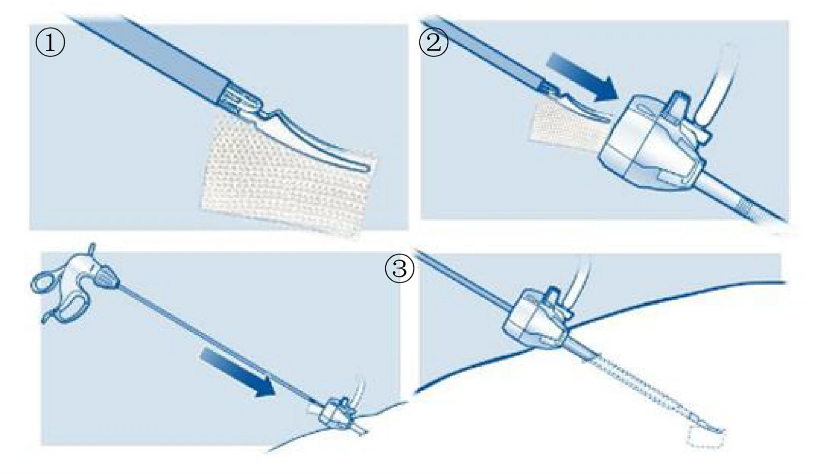 oxidized-cellulose-hemostatic-agent oxidized-cellulose-hemostatic-agent